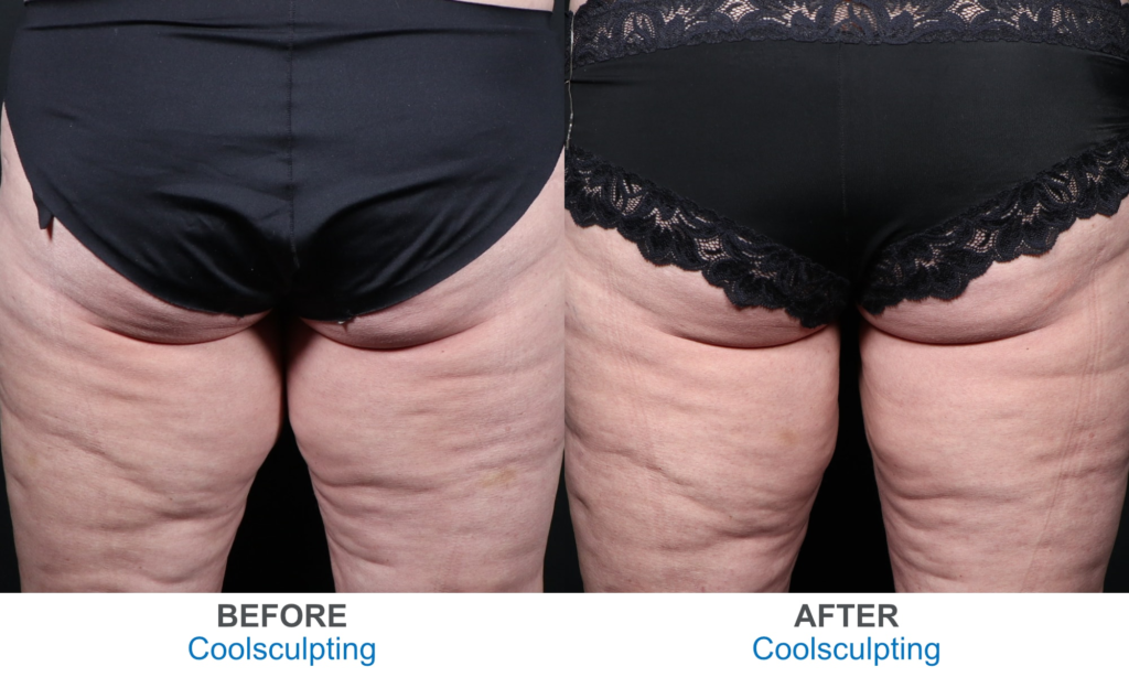  lagree before and after 3 months - leg sculpt inner thigh